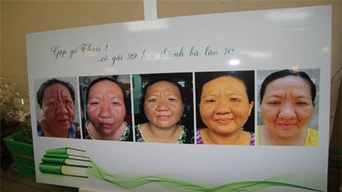 mĩ phẩm, corticoid, cô gái hóa bà lão