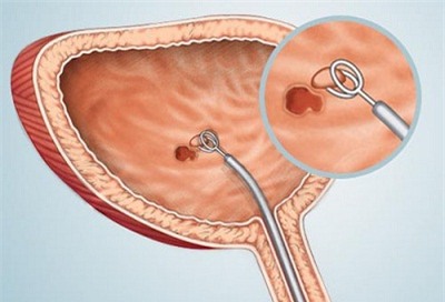 Những nguyên nhân gây tiểu đêm