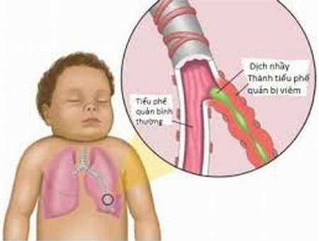 Nhận biết và phòng ngừa viêm tiểu phế quản ở trẻ 1