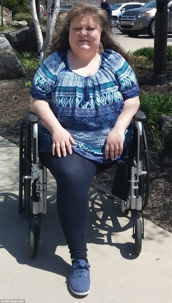 Bị muỗi đốt, người phụ nữ phải cưa chân để giữ tính mạng - Ảnh 1