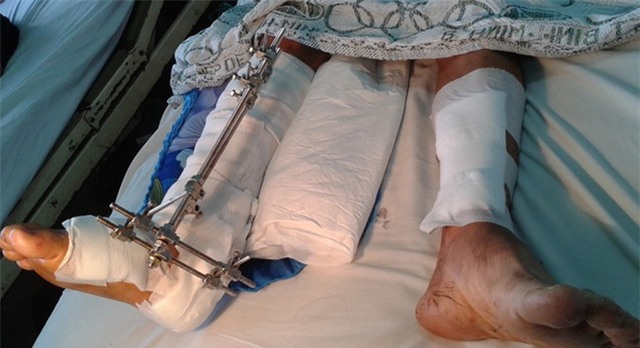 Cứu hai bệnh nhân bị máy nông nghiệp chém lìa chân