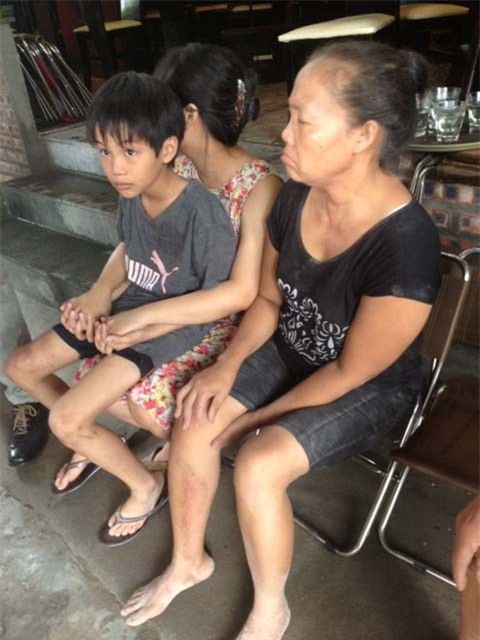 Nạn nhân tên Trần Thị Sửu (55 tuổi) vừa được cứu ra khỏi đống đổ nát, cho biết trên tờ VOV: Tôi đang đứng trong nhà thì sập xuống, bị thương ở chân. Bị gạch vữa đè lên người. Ba mẹ con bị mắc kẹt trong nhà. Cháu nhỏ nhất 7 tuổi. Cháu thứ 2 học đại học.&nbsp;Trước đó có hiện tượng rung lắc. Nhà sập không phải do nổ bình gas. Hiện tại còn nhiều người mắc kẹt không, còn nhiều người mắc kẹt, vì đang giờ buổi trưa. Hiện tại tôi rất hoảng sợ và bấn loạn.