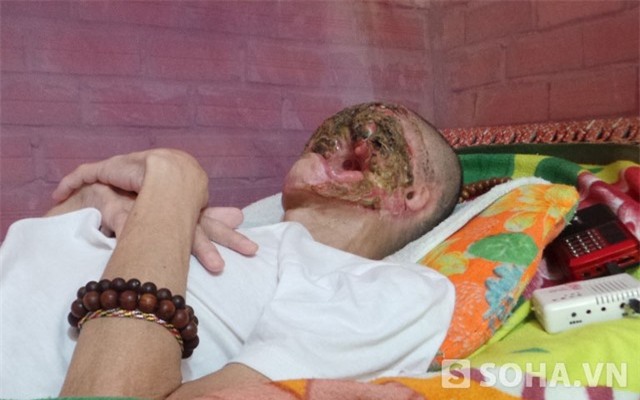 Anh Đạt cho rằng nếu để người khác nhìn thấy mặt thì họ sẽ sợ và xa lánh