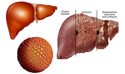 4 loại bệnh để lâu sẽ dẫn đến ung thư - 3