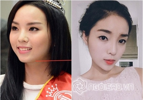 Bằng chứng Hoa hậu Kỳ Duyên tiêm botox v-line 1