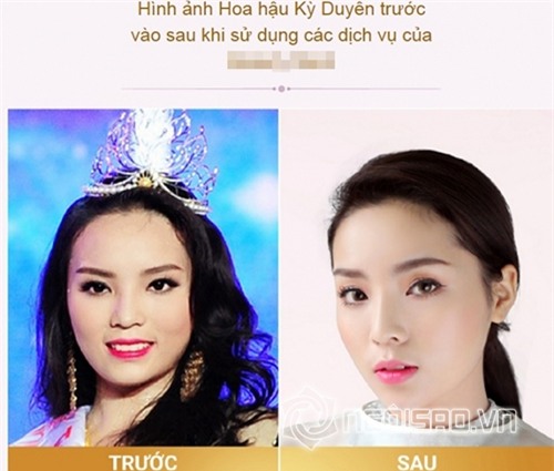 Bằng chứng Hoa hậu Kỳ Duyên tiêm botox v-line 4