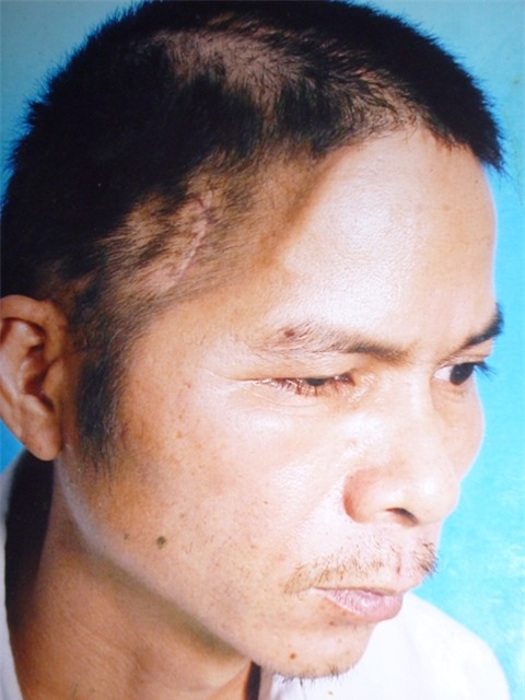 Sau tai nạn, anh Thích mất 1/3 hộp sọ, di chứng kéo dài đến nay khiến anh bị ảnh hưởng thần kinh và khả năng vận động