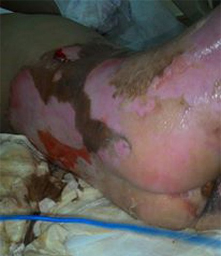 Lưng bé Huyền Trang bị bỏng quá khủng khiếp, có chỗ vết bỏng ăn sâu vào da thịt, máu mũ vẫn chảy nhiều.