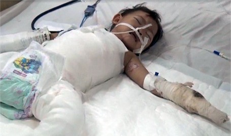Toàn thân bé Huyền Trang được băng bó để vùng tổn thương không nhiễm khuẩn, lở loét