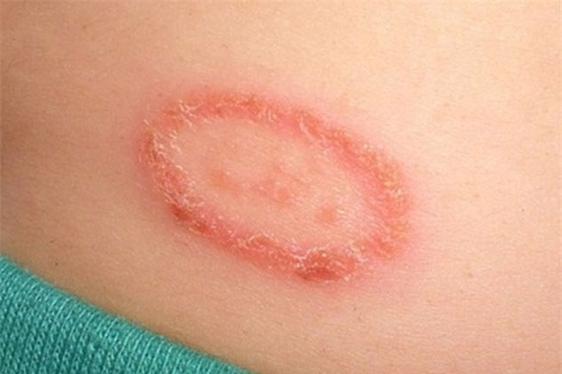  Viêm da tiếp xúc khi bị dính chất độc của kiến ba khoang (Ảnh minh họa) 