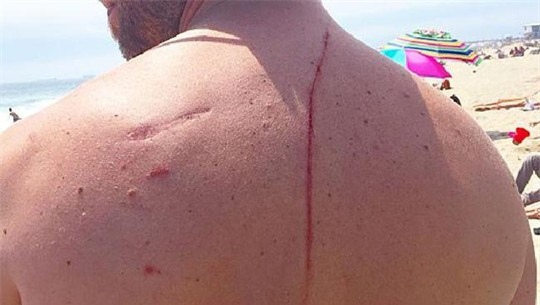 Anh Eugene Finney bị thương ở lưng. Ảnh: CBS Boston