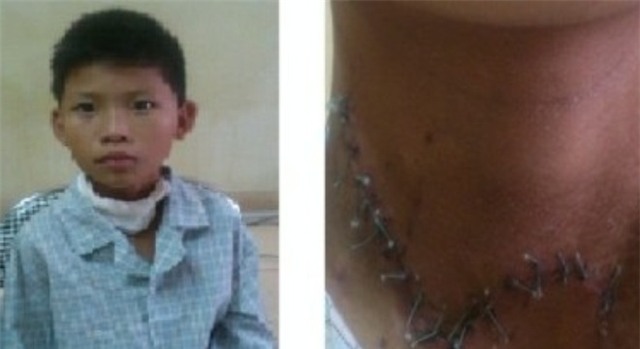 Bé trai 12 tuổi bị tấm tôn cứa đứt khí quản