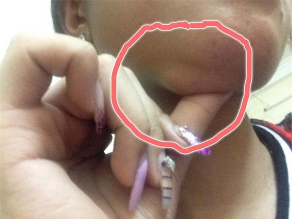 tiêm chất làm đầy