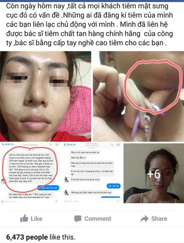 tiêm chất làm đầy