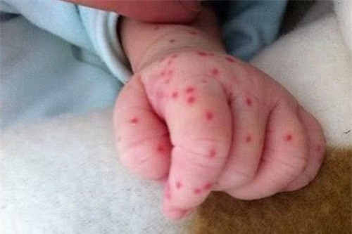 Chấm xuất huyết dưới da trong bệnh sốt xuất huyết .