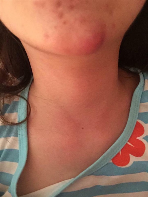 Spa bị tố tiêm chất làm đầy dởm khiến mũi lệch, môi sưng