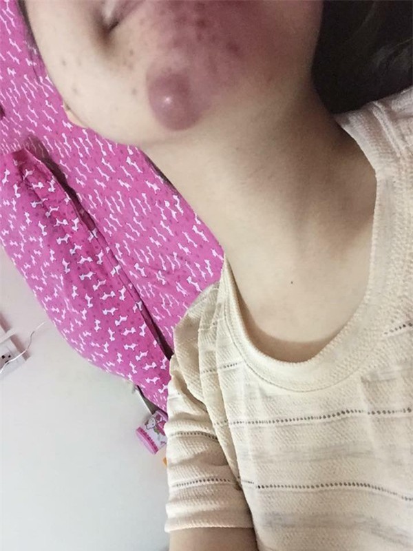 Spa bị tố tiêm chất làm đầy dởm khiến mũi lệch, môi sưng