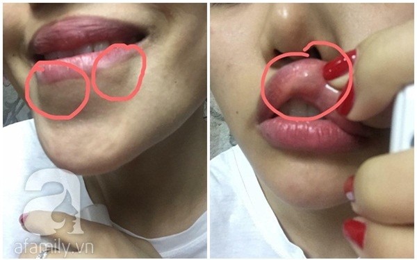 Vụ tiêm chất làm đầy dởm: Khách hàng sẵn sàng ra đối chất với hot girl chủ spa