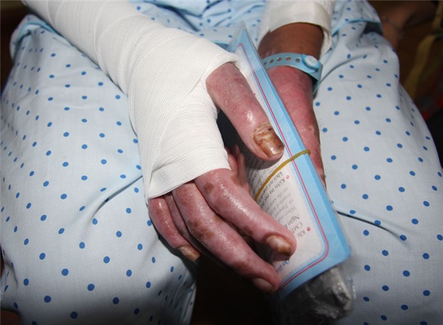 bé gái bị mẹ đốt, tẩm xăng, xuất viện