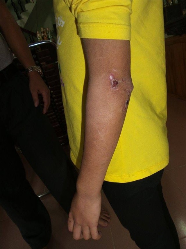 Những vết thương trên cánh tay của cháu P.