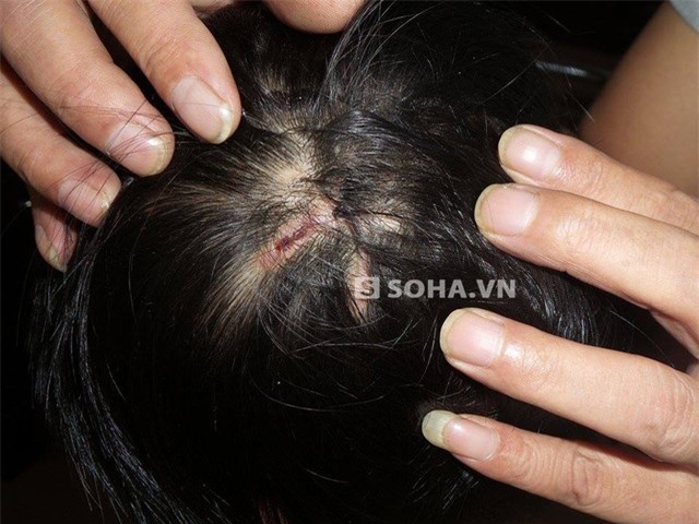 Trên đầu cháu P. có rất nhiều vết thương mới lành và đang ăn da non.