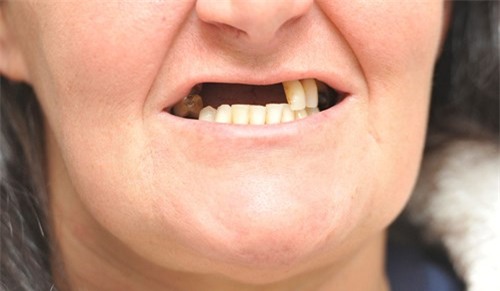 Người phụ nữ bay mất nửa hàm răng vì ham rẻ - ảnh 2