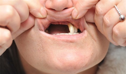 Người phụ nữ bay mất nửa hàm răng vì ham rẻ - ảnh 3