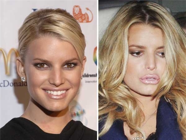 Sao Hollywood dị dạng vì lạm dụng chất làm đầy