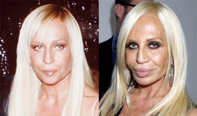 6. Donatella Versace: Nhà thiết kế thời trang nổi tiếng của thương hiệu Versace là một trong những tín đồ nghiện trùng tu nhan sắc. Tuy nhiên, thay vì trở nên xinh đẹp, bà lại là thảm họa thẩm mỹ ở Hollywood. Theo nhận định của các bác sĩ phẫu thuật ở New York, bà đã nâng mũi, bơm môi, căng da mặt, tiêm chất độn và botox. Đôi môi phình to, mũi hẹp, cơ mặt khó cử động là những điểm biến dạng trên khuôn mặt của Donatella. Ảnh: Womansday