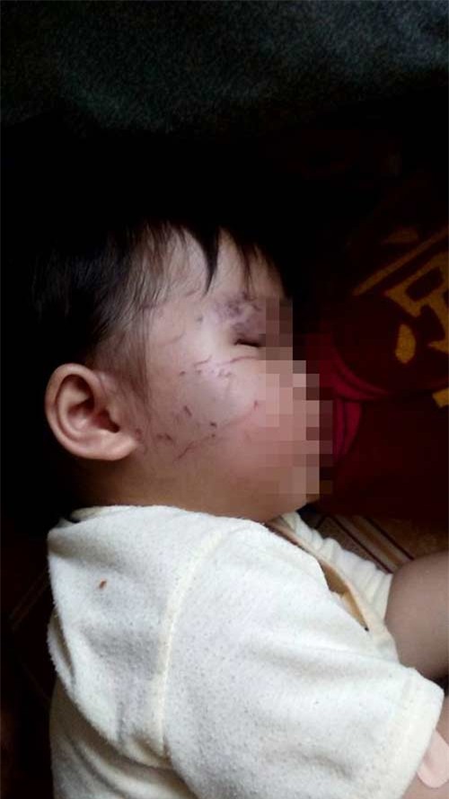 Bé 11 tháng tuổi bị bạn cắn, cào nát mặt khi đi nhà trẻ - 2