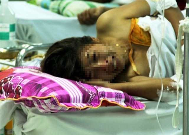 Chị Nhài đau đớn tại bệnh viện với vết bỏng 30%.