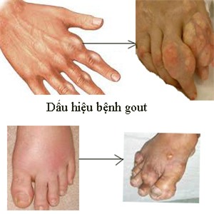 Dấu hiệu chỉ điểm bệnh gút