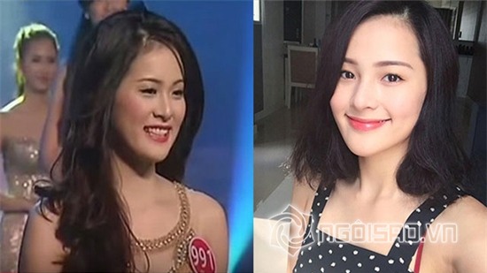 Tình mới Cường Đô la để lộ vết tích dao kéo cằm 4