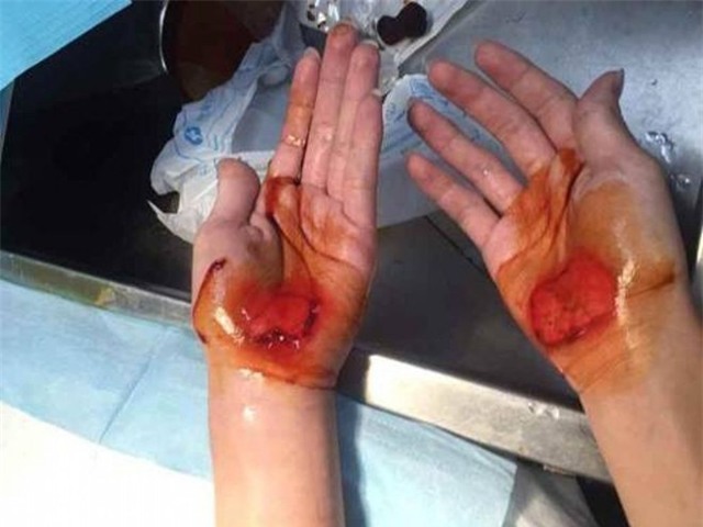 Cô giáo phạt học sinh đi bằng tay đến chảy máu