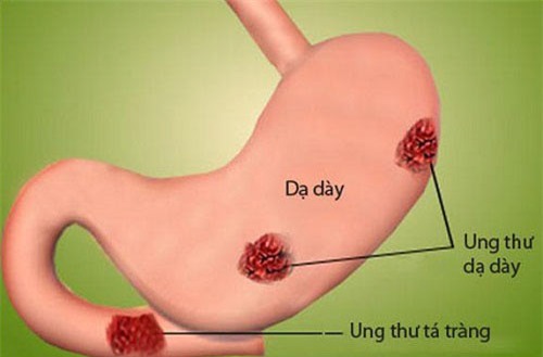 Ăn mặn có thể làm tăng nguy cơ mắc ung thư dạ dày - 2