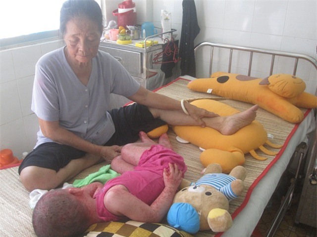 Nhói lòng bé 3 tuổi bị vẩy nến mủ toàn thân - 2