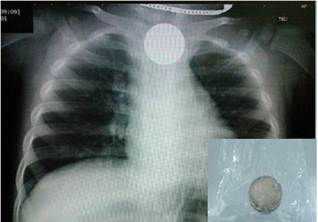 Bé 6 tuổi nuốt đồng xu vào thực quản