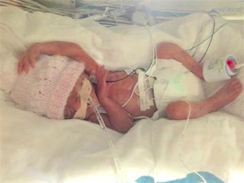 Bà mẹ kể lại giây phút kinh hoàng khi sinh non ở tuần 23 - 2