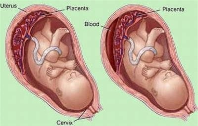 Tránh sốt xuất huyết khi mang bầu: Cách gì?