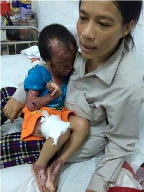 Thương tâm bé 4 tuổi bị bỏng nặng ở vùng mặt - 1