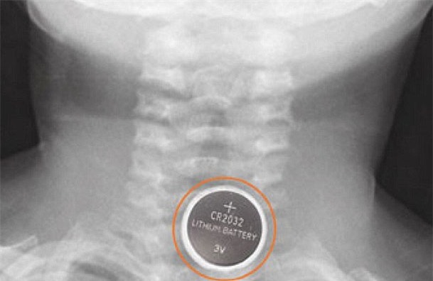 pin cuc ao, nuot pin, bong co hong, tre em, rui ro, pin cúc áo, nuốt pin, bỏng cổ họng, trẻ em, rủi ro, tử vong