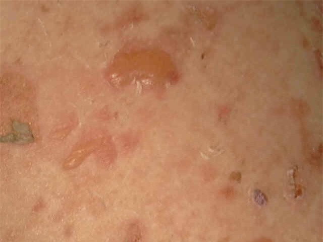 4 căn bệnh da liễu gây tử vong ít người biết