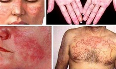 Một số tổn thương cơ thể do Lupus ban đỏ. Ảnh: SKĐS