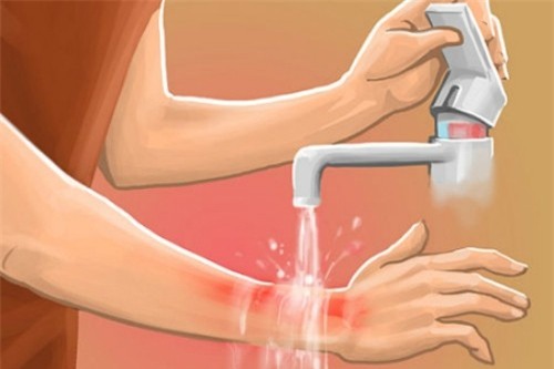 Xối nước sạch nhẹ nhàng vào vết bỏng ngay sau khi bị bỏng.