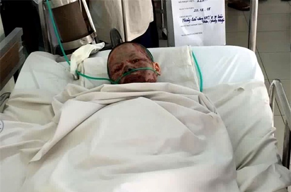 Xót thương cô gái xinh đẹp bị hủy hoại toàn bộ cơ thể do người yêu tạt xăng đốt - Ảnh 2.