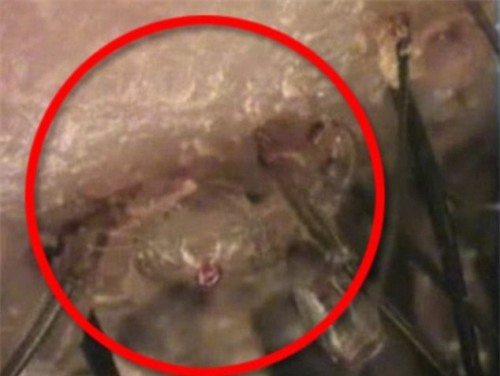 Kinh hãi phát hiện hàng trăm con rận mu bám trên mi mắt bé 6 tuổi - Ảnh 2