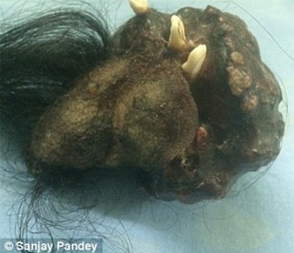 Đau bụng đi khám mới phát hiện ra xác anh em sinh đôi trong cơ thể - Ảnh 3.