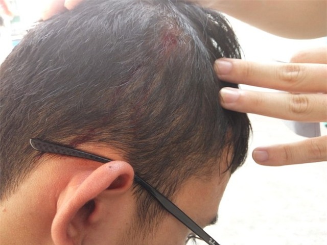 Điều tra vụ sinh viên đi xin việc bị đánh vỡ đầu