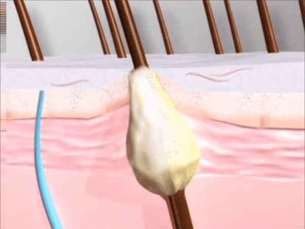 dùng nước có ga để rửa mặt