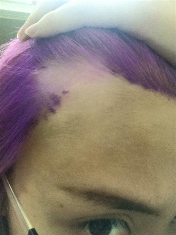 Cô gái nhuộm tóc đến nổ cả da đầu và tóc rụng từng mảng khiến dân mạng hoang mang - Ảnh 2.
